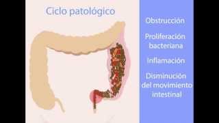 Hirschsprung Colitis and Fecal incontinence [upl. by Laure]