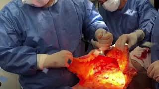 Abdominoplastia Dr Hernando Tenorio [upl. by Sileray]