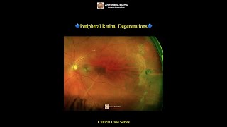 Peripheral Retinal Degenerations [upl. by Hemminger595]