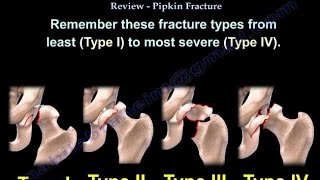 Femoral Head Fracture Review Pipken Fracture  Everything You Need To Know  Dr Nabil Ebraheim [upl. by Iliam]