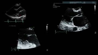 Mitral valve  regurgitation [upl. by Ragan]