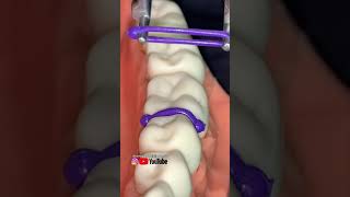 Orthodontic Separators Explained 😬 braces [upl. by Izak]