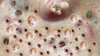 Blackhead Removal With Sac Dep Spa 100074051 [upl. by Josler351]