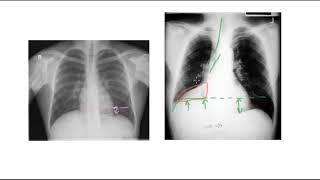 🔴 PNEUMONIE PLEURESIE INFARCTUS OU ATELECTASIE [upl. by Marras]