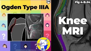 Fig 4B24 Ogden Type IIIA Tibial Tuberosity Fracture [upl. by Aitsirhc]