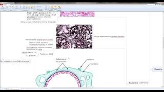 Glomerulonephritis overview  concept map [upl. by Tloc]