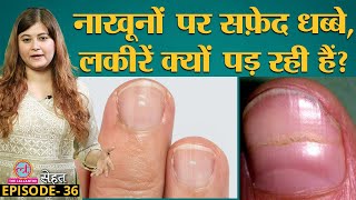 Nails पर White Spots Beaus Lines क्यों पड़ते हैं Doctors से समझिए  Sehat Ep 36 [upl. by Melvena27]