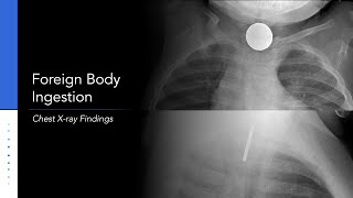 Foreign Body Ingestion Chest Xray [upl. by Pascale]