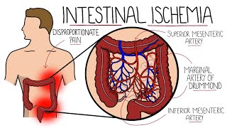 Intestinal Ischemia  Mesenteric Ischemia Acute amp Chronic amp Ischemic Colitis [upl. by Nadda]