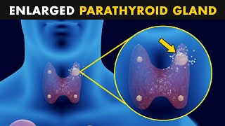 Hyperparathyroidism  Symptoms Causes And Treatment [upl. by Utham]