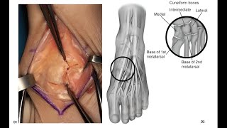 Lisfranc Joint Exposure Expert Reveals the Hidden Dangers [upl. by Babcock]