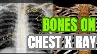 CHEST XRAYBONESREFLECTION 1B8 [upl. by Durer]