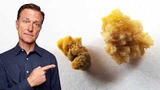 The Deeper Cause of Kidney Stones Youve Never Heard About [upl. by Fogg]