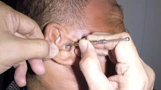 Something MASSIVE Stuck amp Removed From Mans Ear [upl. by Ilagam447]