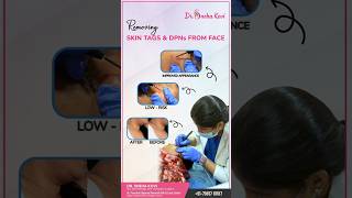 Say Goodbye to Skin Tags and DPNs from Face with Dr Sneha Kovi [upl. by Novelc]