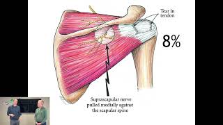 Suprascapular Neuropathy  ChiroUp [upl. by Noakes]