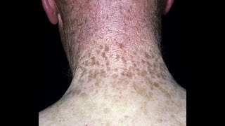 The Language of Dermatology Part I Plus Nevus Flammeus Lentigo Ephelides freckles and Melasma [upl. by Yna]