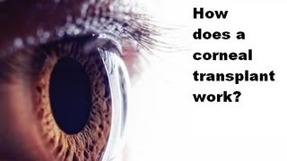 How is a corneal transplant done [upl. by Harihat974]