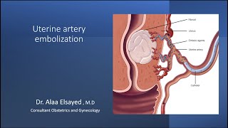 Uterine Artery Embolization UAE [upl. by Eilyah]