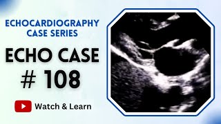 ECHO CASE 108  Echocardiography For Beginners [upl. by Ytsanyd]