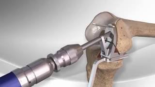 Best Knee Arthroscopy Exercises from 2 to 6 Weeks Postop [upl. by Elianora]