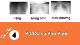 PiCCO phần 3 Tiên đoán phù phổi và nguyên nhân phù phổi như thế nào [upl. by Oderfla]