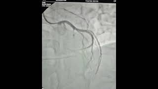 Primary Angioplasty amp Stenting Procedure to LAD via Right Radial Artery  Best Cardiac Hospital Agra [upl. by Azilanna]