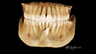 Surgical Extraction of an Impacted Mandibular Canine [upl. by Tufts474]