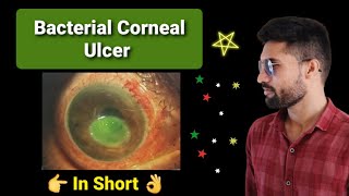 Bacterial corneal ulcer lecture opthalmology [upl. by Pressman]