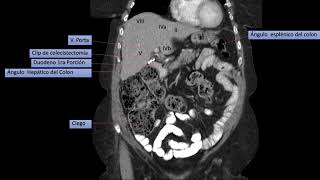 TOMOGRAFIA CORONAL BASICA DE ABDOMEN Y PELVIS [upl. by Cristiona770]