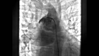 Non Confluent Pulmonary Arteries [upl. by Eirena]