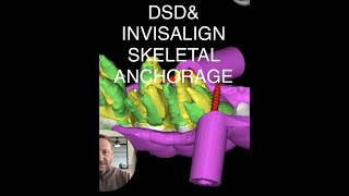 How a Facially Airway and TMJ Driven Ideal Design will guide the Orthodontic Treatment [upl. by Burtie194]