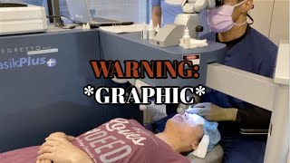 FULL LENGTH Uncut Footage of Lasik Wavefront Surgery with LasikPlus [upl. by Brunhilda]