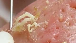 Blackheads amp Whiteheads Satisfying Removal 0078 [upl. by Kcirdez]