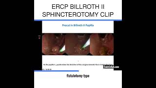 ERCP Billroth II Sphincterotomy Clip [upl. by Douty]