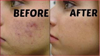 How To Remove Dark Spots Acne Scars Black Spots In Just 3 Days  Get Flawless Glowing Skin [upl. by Allin194]