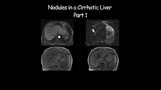 Nodules in a Cirrhotic Liver  Part 1 radiology radiologist cirrhosis liverdisease liverhealth [upl. by Aerb]