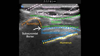 Subacromial bursa injection [upl. by Simonne63]