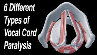 Vocal Cord Paralysis 6 Different Types of Paralysis and How It LooksMoves [upl. by Onitsuaf]