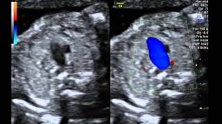 Tetralogy of Fallot with pulmonary atresia [upl. by Nauqet]