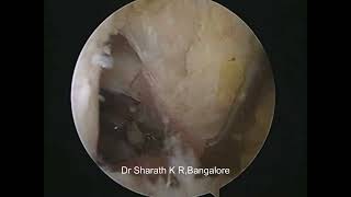 ALL INSIDE PCL RECONSTRUCTION USING PERONEUS LONGUS AUTOGRAFT [upl. by Arvie]