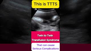 TTTS  Twin to Twin Transfusion Syndrome Ultrasound  Monochorionic TWINS [upl. by Reseda]