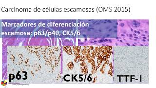 Clasificacion patologica de cáncer de pulmón de no células pequeñas Dr Hugo Castro Grupo Angeles [upl. by Yatnuahs]