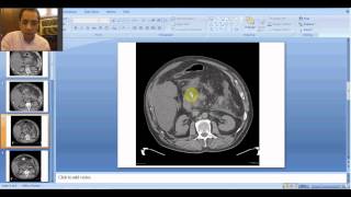 Radiology Spotter Part21 Acute Pancreatitis [upl. by Eilraep]