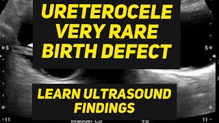 Ureterocele ultrasound finding  Birth defect [upl. by Fern]