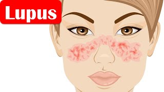 Lupus SLESystemic Lupus Erythematosus  Causes Pathogenesis Symptoms Diagnosis Treatment [upl. by Hardigg56]