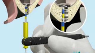 The Original SinuDrill by Innovative Implant Technology [upl. by Sjoberg]