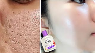 How to use Lacto Calamine Lotion  Lacto Calamine Lotion For Clear Spotless Brighten Skin [upl. by Pages100]