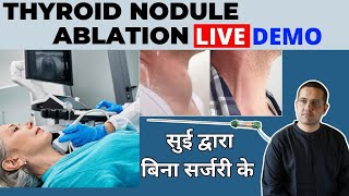 LIVE THYROID NODULE ABLATION  Nonsurgical treatment of Thyroid Nodule  Dr Gaurav Gangwani [upl. by Siubhan]