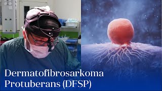 “Dermatofibrosarkoma Protuberans DFSP”  UzmDrDilqəm Məmmədov [upl. by Saimon]